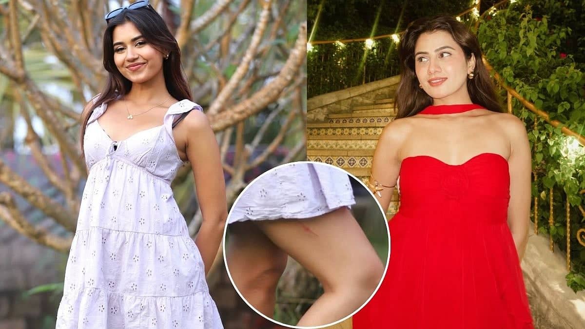 Akanksha Choudhary Flaunts Scar from Splitsvilla Showdown